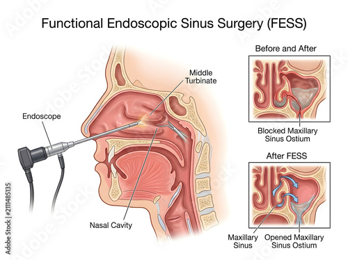 Functional endoscopic sinus surgery (fess) procedure illustration isolated on white background