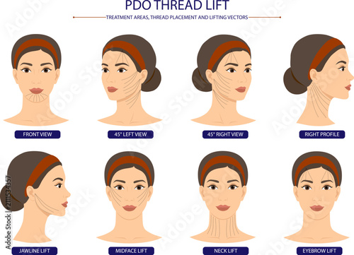 PDO Thread Lift Face Mapping Diagram Showing Thread Insertion Patterns and Lifting Vectors for Aesthetic Medicine. Thread Placement and Lifting Vectors for Facial Rejuvenation Medical Illustration
