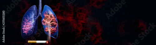 Fotografie Human Lung Cancer with Progressive Tumor Development Cancer Root Extension Pulmo