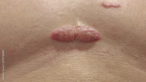 Keloid scar tissue on human skin closeup
