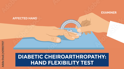 фотографія Diabetic Cheiroarthropathy Joint Contracture Hand Flexibility Test