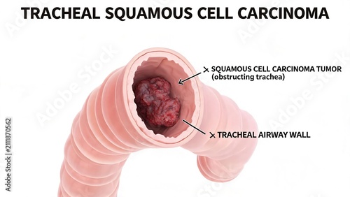 Plain white background labeled 3D anatomical render of tracheal squamous cell carcinoma, front view tracheal lumen with obstructing malignant tumor mass narrowing airway respiratory system pathology i