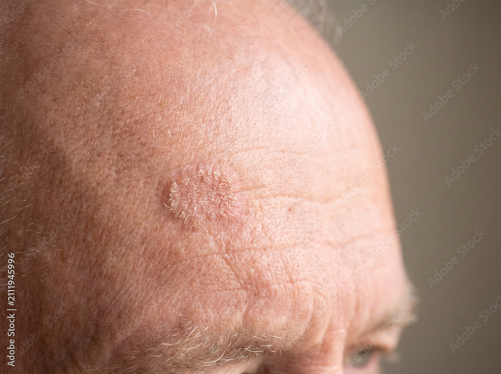 Fototapeta premium Elderly man forehead with actinic keratosis showing rough scaly sun-damaged skin patch, precancerous skin lesion dermatology concept