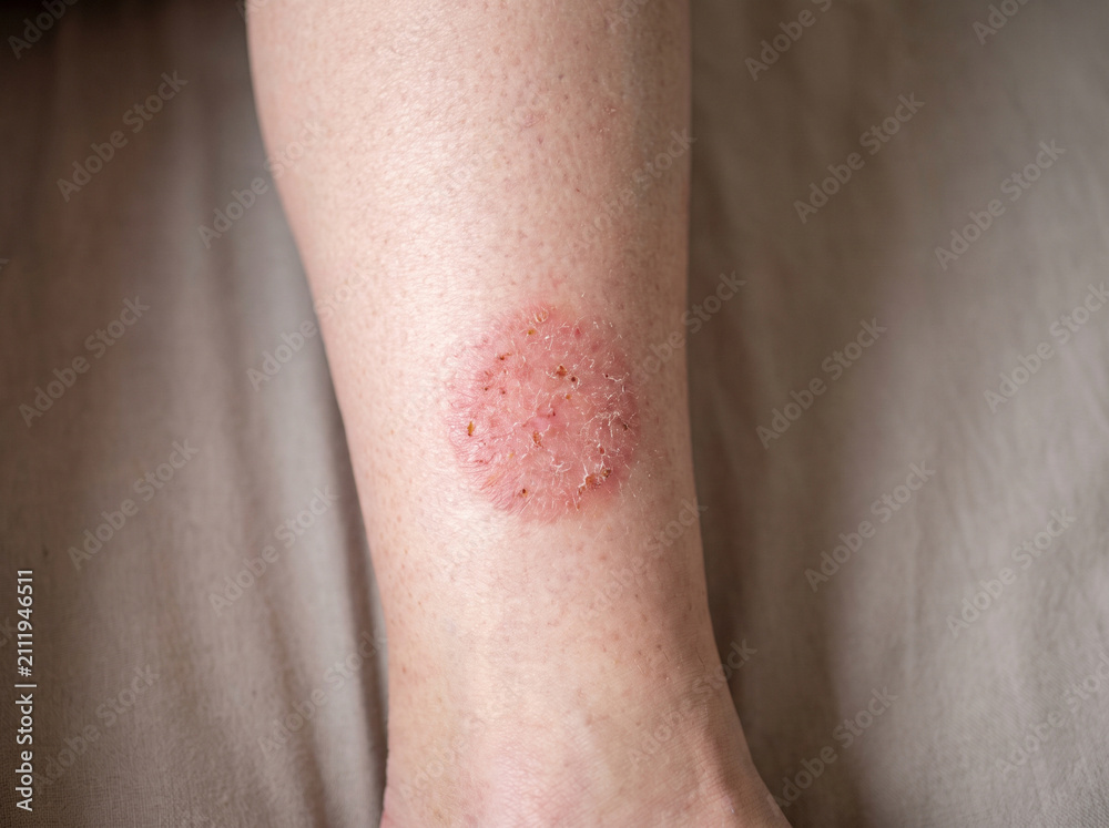 Fototapeta premium Lower leg with nummular eczema showing round coin-shaped red scaly patch on shin, discoid dermatitis skin condition medical concept
