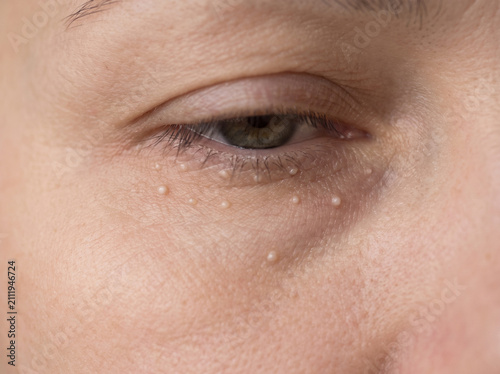 Close-up of under eye skin with milia showing small white pinpoint bumps, common benign skin condition dermatology concept
