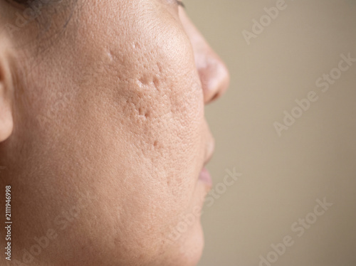 Adult cheek with atrophic acne scars showing pitted depressed skin texture, post-acne scarring dermatology skin condition concept