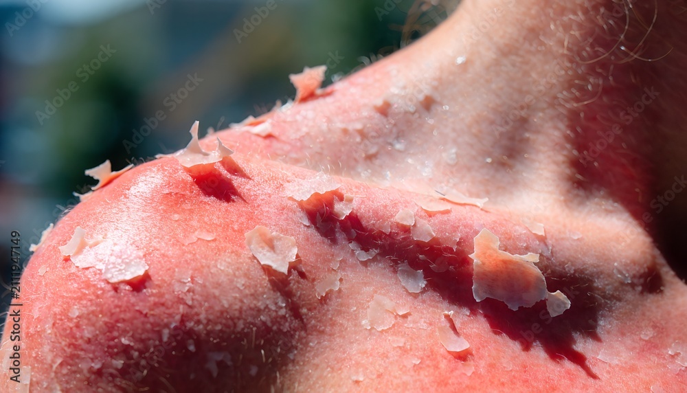 Fototapeta premium Severe Sunburn With Peeling Skin On A Human Shoulder Under Bright Natural Sunlight Close Up View