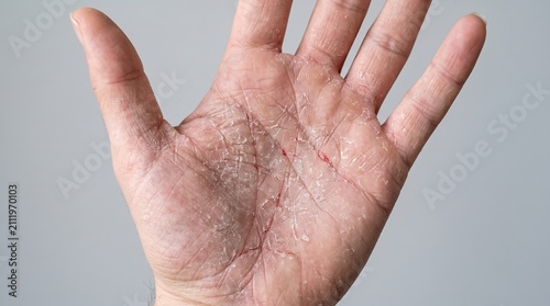 Open palm view of severe palmar eczema with dry cracked skin and painful fissures