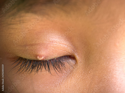 фотографія Close-up of a human eyelid affected by a stye, showing a small inflamed bump along the eyelash line