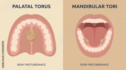 Tableau sur toile Palatal Torus Mandibular Tori Bony Protuberance