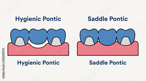 Принти на полотні Dental Bridge Pontic Design Types Hygienic Saddle