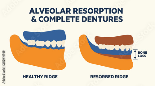 Foto Complete Denture Alveolar Resorption Bone Changes