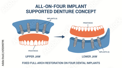 Foto All-on-Four Implant Supported Denture Concept