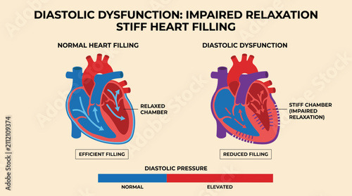Fotografie Diastolic Dysfunction Impaired Relaxation Stiff Heart Filling Diagram
