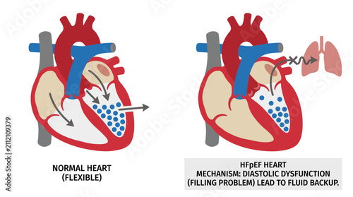 Fotografie Heart Failure With Preserved Ejection Fraction HFpEF Mechanism