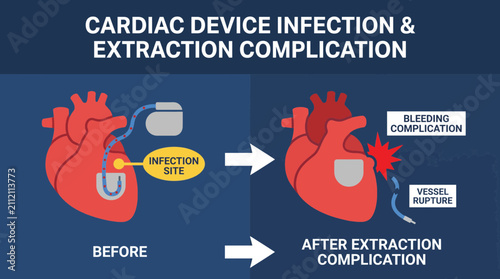 Fotografie Cardiac Device Infection Pacemaker Lead Extraction Complication Diagram