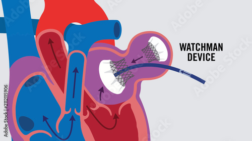 Percutaneous Left Atrial Appendage Closure Watchman Device Diagram