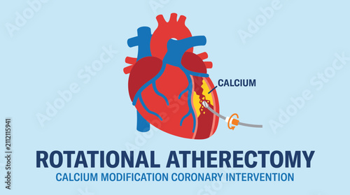 Obraz na płótnie Rotational Atherectomy Calcium Modification Coronary Intervention