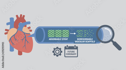 Foto Bioresorbable Vascular Scaffold Absorbable Stent Future Coronary