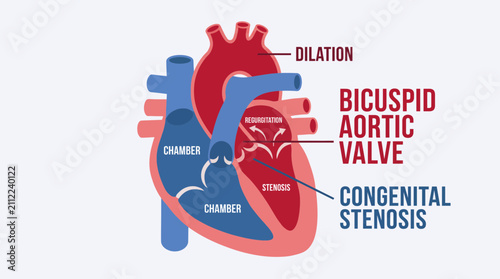 Photography Bicuspid Aortic Valve Congenital Stenosis Regurgitation Dilation