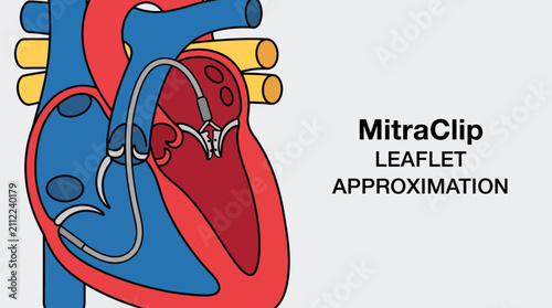 Fotografía Transcatheter Mitral Valve Repair MitraClip Leaflet Approximation