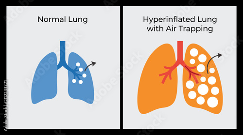 Canvastavla Lung Hyperinflation Air Trapping in Obstructive Airway Disease