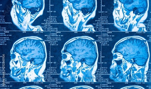 Blue MRI scans show human brain cross-sections. No emotions visible as no people are depicted. Medical, research, or educational use advised. Suitable for neuroscience, diagnostics