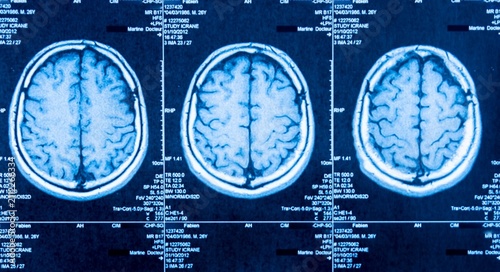 Three brain scans in medical imaging format. Blue tones highlight cerebral structures. No facial expressions or human emotions shown. Ideal for health, neuroscience, or medical education