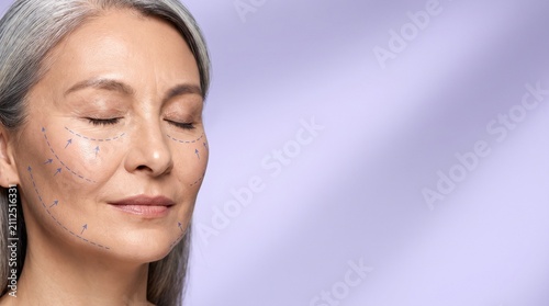Mature woman with eyes closed and face lift markings on skin.