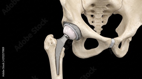 Total Hip Replacement Prosthesis Human Model