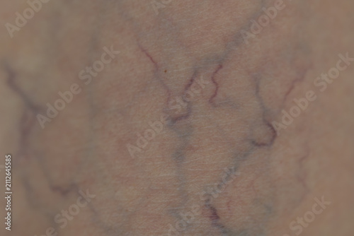 Quadro su tela Human skin showing spider veins and superficial capillaries in close-up