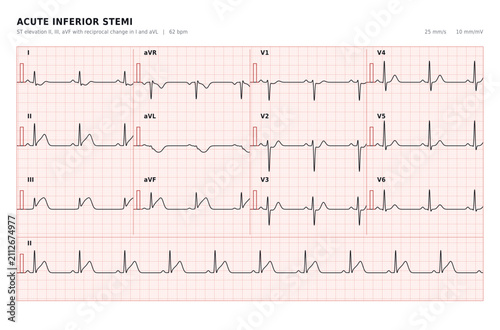 Acute Inferior STEMI 12-Lead ECG with ST Elevation in Leads II III and aVF