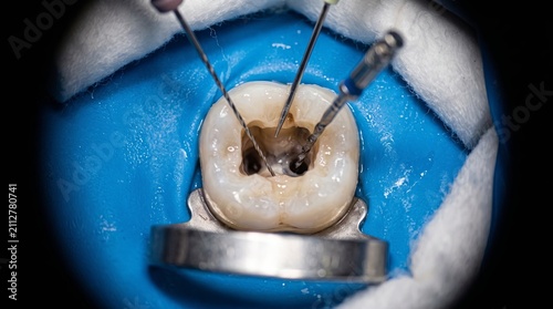 Microscopic Endodontic Treatment with Rubber Dam Isolation and Fine Dental Instruments