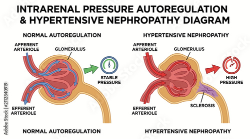 Canvastavla Intrarenal Pressure Autoregulation Hypertensive Nephropathy Diagram