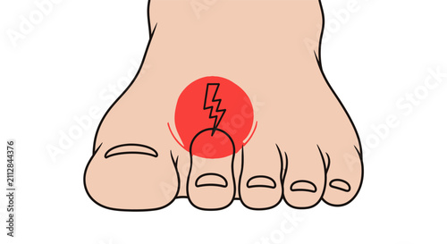 Vector illustration of a human foot with a red highlighted circle and a lightning bolt symbol on the second toe, indicating pain or injury. Healthcare, podiatry, and medical concept.