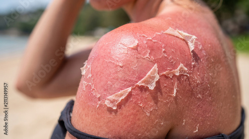Close-Up of Severe Sunburn With Peeling Skin on Human Shoulder After UV Exposure