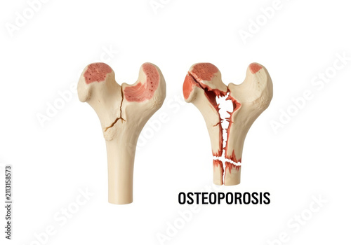 Osteoporosis bone fracture medical anatomy femur skeletal disease fragile bone health study model on white background