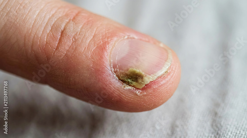 Close-up of finger with fungal infection and discoloration nail