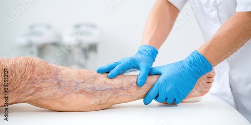 Phlebologist examines a patient with varicose veins on his leg. Leg pain. Phlebology. Venous pathologies of the lower extremities. Human vessel, arteries. Capillaries. Blood system. Health legs