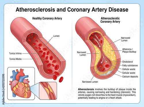 Atherosclerosis vs healthy coronary artery comparison