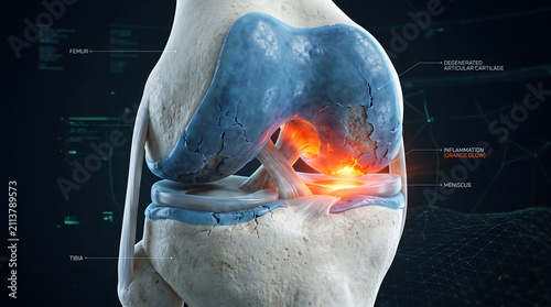 3D medical illustration of knee joint osteoarthritis showing degenerated cartilage and glowing red inflammatory response