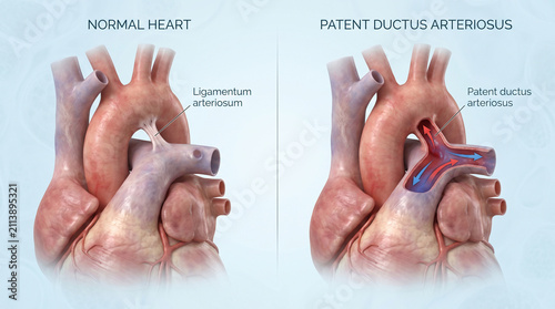 3D Anatomy of Normal Infant Heart and Patent Ductus Arteriosus