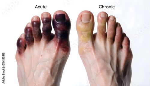 Toe contusion injury comparison showing different stages of recovery, isolated on white background