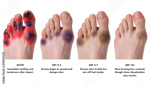 Multiple bruised toes from trauma impact with stage comparison, isolated frontal foot view