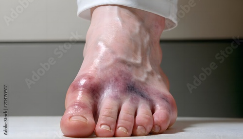 Severe Lisfranc midfoot injury with visible skin discoloration and swelling, dorsal view of foot