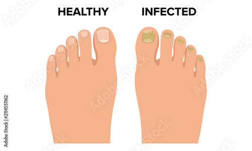 Toenail fungus comparison between healthy and infected human feet