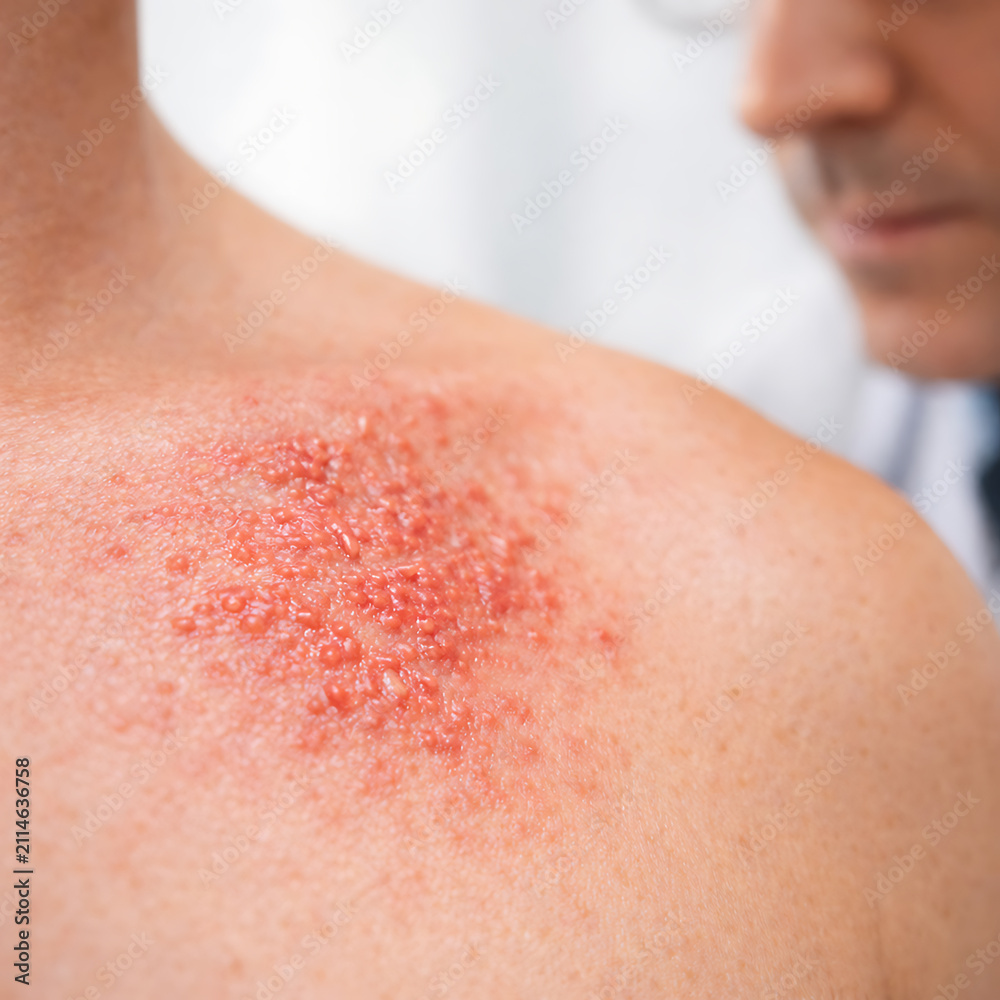 Fototapeta premium Close up of irritated shoulder rash with blurred doctor examining skin condition in clinic