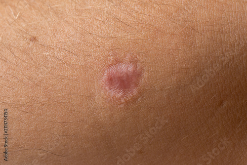 Close up of healing surgical scar after mole removal on human skin showing healing and dermatology treatment