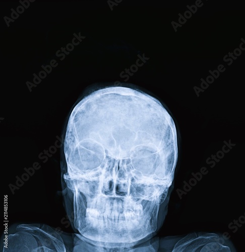 Frontal skull radiograph showing calvarial bone vault orbit cavities and facial structure