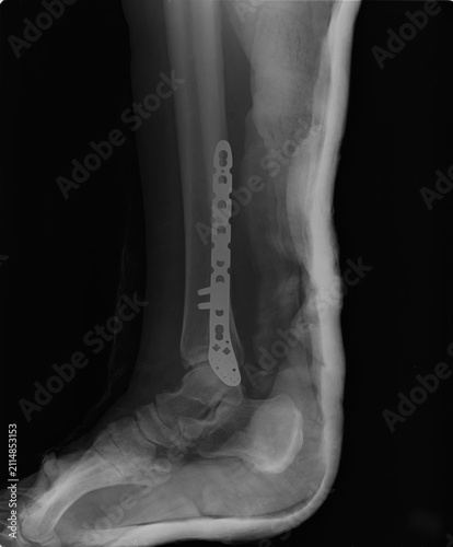 Foto Lateral X-ray view of right ankle joint with contoured orthopedic plate and post